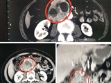 泌尿外科成功完成巨大腹膜后嗜铬细胞瘤一例