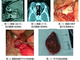 我院眼科成功完成一例眼眶肿瘤手术