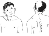 【健康科普】认识先天性肌性斜颈