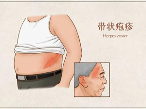 医讯——《聊聊带状疱疹那些事儿》线上健康宣讲