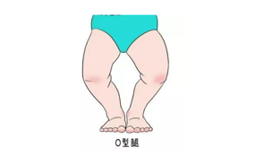 医讯——《O型腿的成因与预防》线上健康宣讲